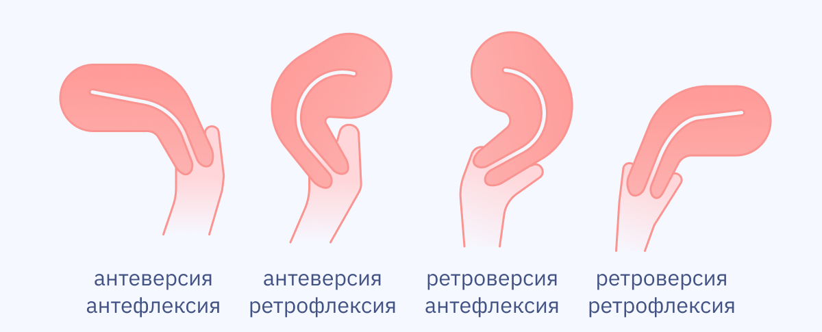 Патология – сексу не помеха! Удобные позы при загибе шейки матки Патология – сексу не помеха! Удобные позы при загибе шейки матки