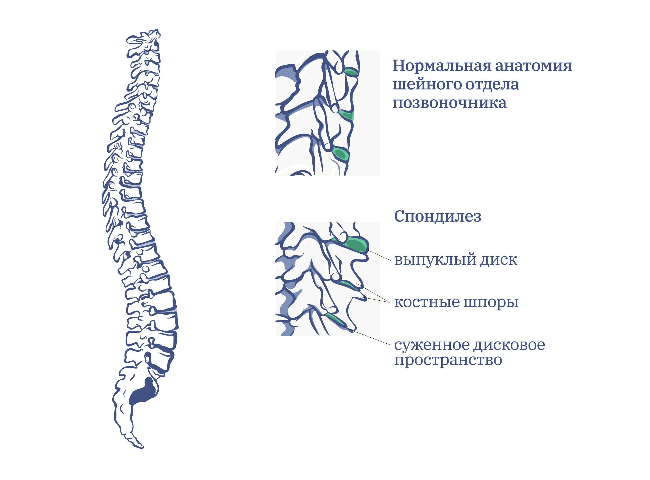 Что такое спондилез поясничного отдела позвоночника. 7 Позвоночник. Шейный отдел позвоночника состоит. Шейный остеохондроз схема. Отделы позвоночника начиная с шейного.