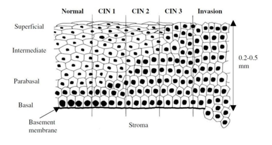 Почему дисплазию шейки матки не лечат антибиотиками и ...